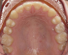 Teeth Before