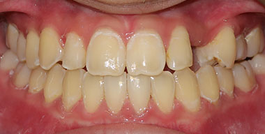 Teeth Before