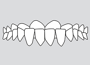 Underbite