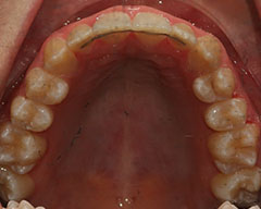Teeth Before