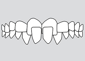 Cross bite